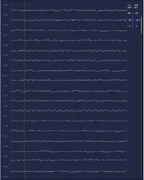 Raw traces across channels, each showing the stable sawtooth of a correctly biased amplifier