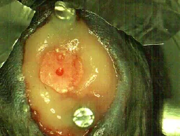 Craniotomy with the cortical surface exposed