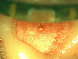 The insertion site after the probe is at depth