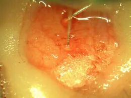 The probe inserted at the target site
