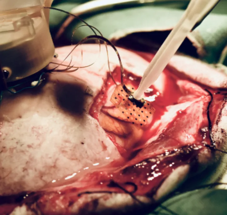 Figure 6. Array placement in vivo In vivo placement of a NeuroNexus electrode array on exposed cortex through a craniotomy in a large-animal preparation